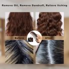Dandruff Comb korpásodás elleni fésű 21,1 × 5,3 cm fejbőr psoriasis és tetű fésű - outlet termék